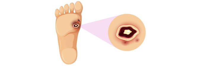 El pie diabético en AudioMédical