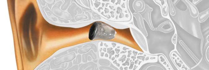 Personalización de Audífonos en Salamanca